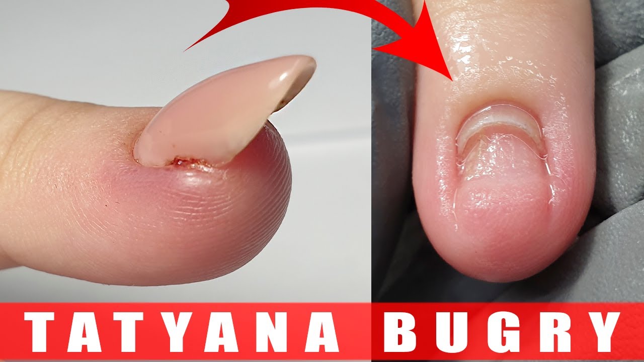 Can a Nail Bed Grow Back: Understanding Nail Bed Healing