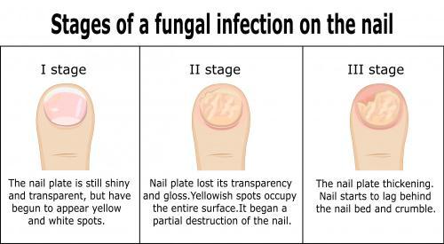 Can a Nail Fungus Spread: Understanding the Spread of Fungal Infections