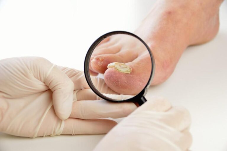 Is a Nail Fungus Contagious: Understanding the Contagious Nature of Fungal Infections