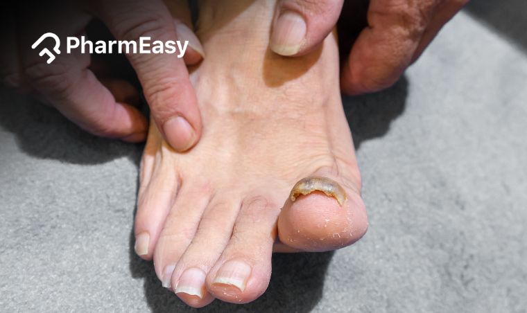 Can Toe Nail Grow Back: Understanding Toe Nail Regrowth