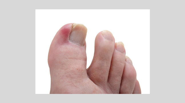 Can Toe Nail Grow Back: Understanding Toe Nail Regrowth