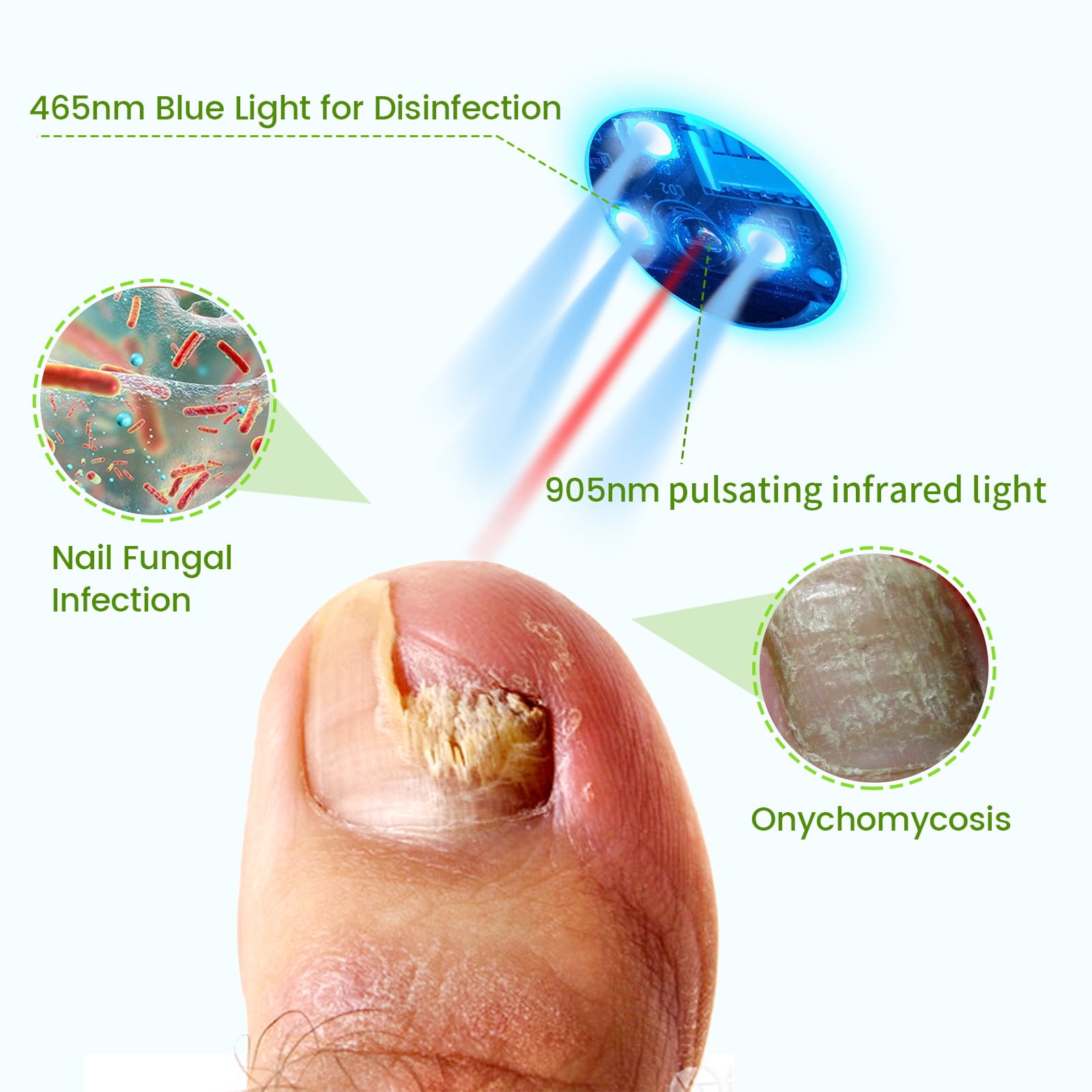 Do Home Nail Fungus Lasers Work: Exploring At-Home Treatments for Nail Fungus