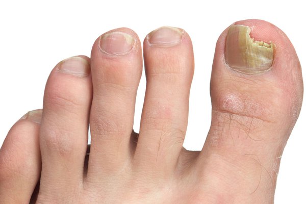 Why Toe Nail Yellow: Exploring Causes of Discolored Nails