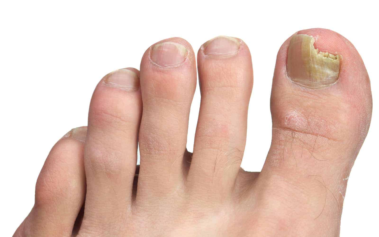 Can Toe Nail Grow Back: Understanding Toe Nail Regrowth