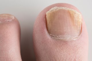 Does a Nail Fungus Hurt: Exploring the Pain Associated with Fungal Infections