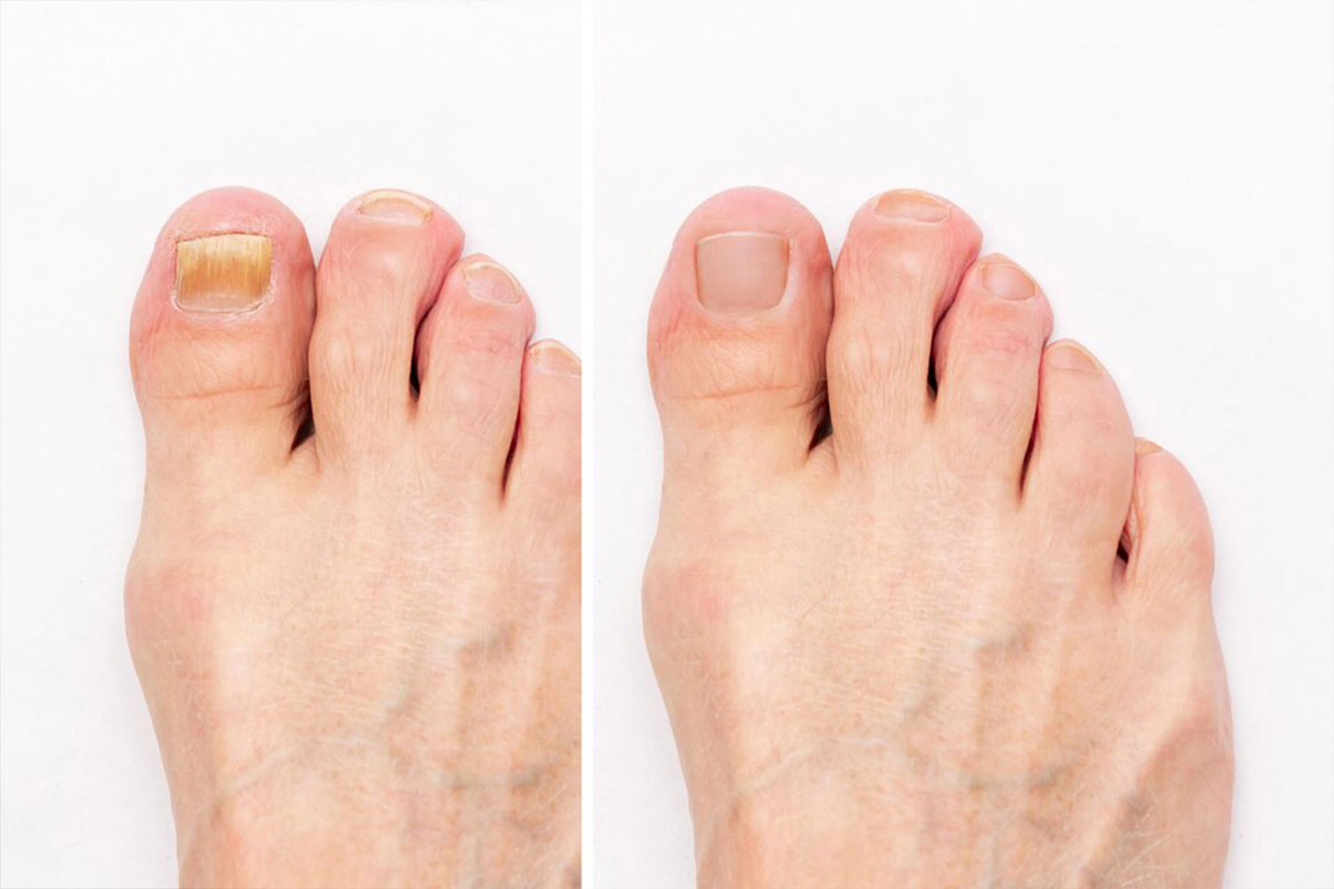 Does a Nail Fungus Hurt: Exploring the Pain Associated with Fungal Infections