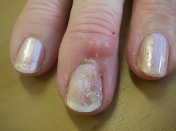 Can Nail Beds Grow Back: Exploring Nail Bed Regrowth