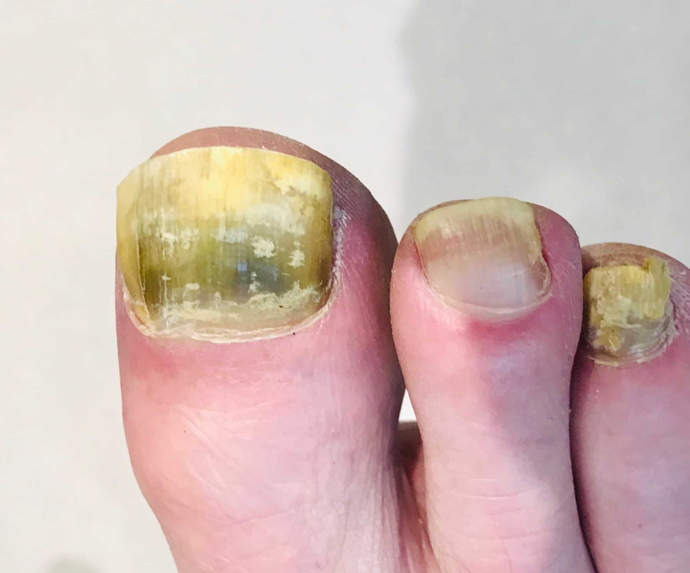 Can a Nail Fungus Spread: Understanding the Spread of Fungal Infections