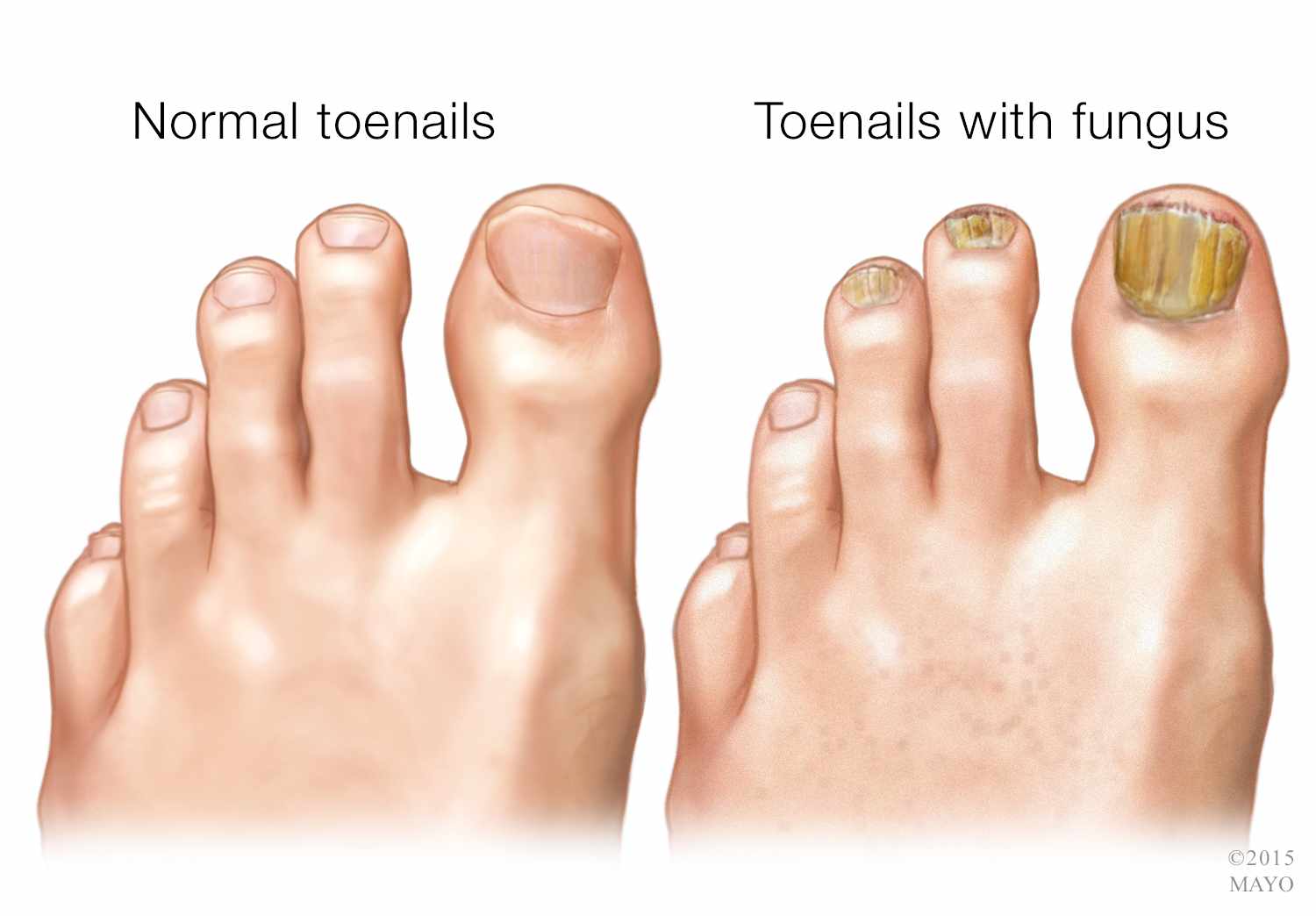 Can Toenail Fungus Spread: Understanding the Spread of Toenail Fungus