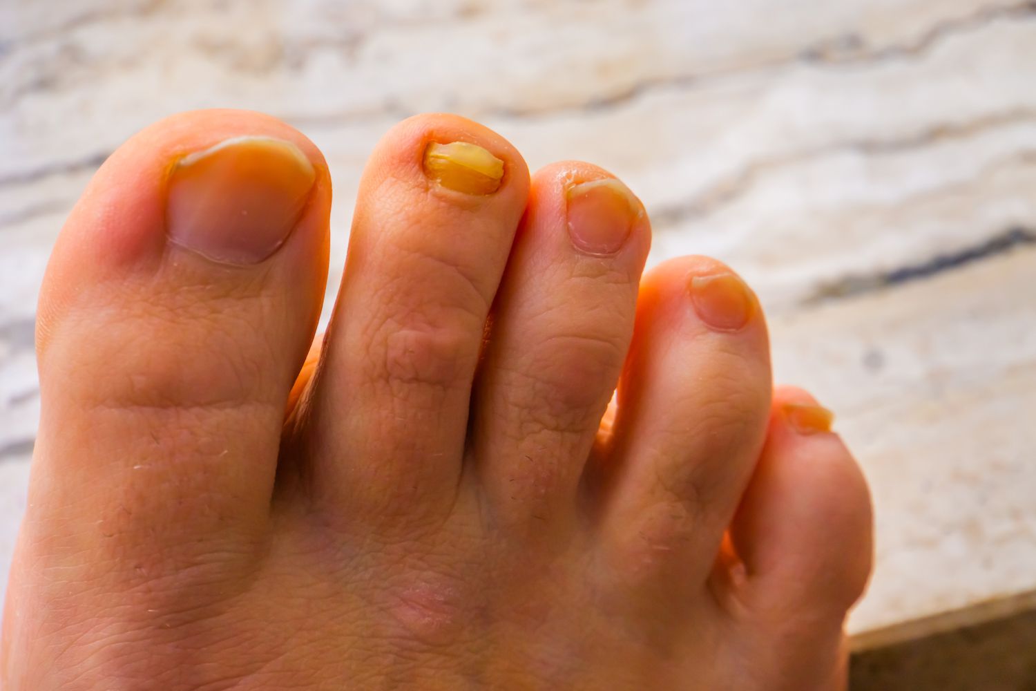 Why Toe Nail Yellow: Exploring Causes of Discolored Nails