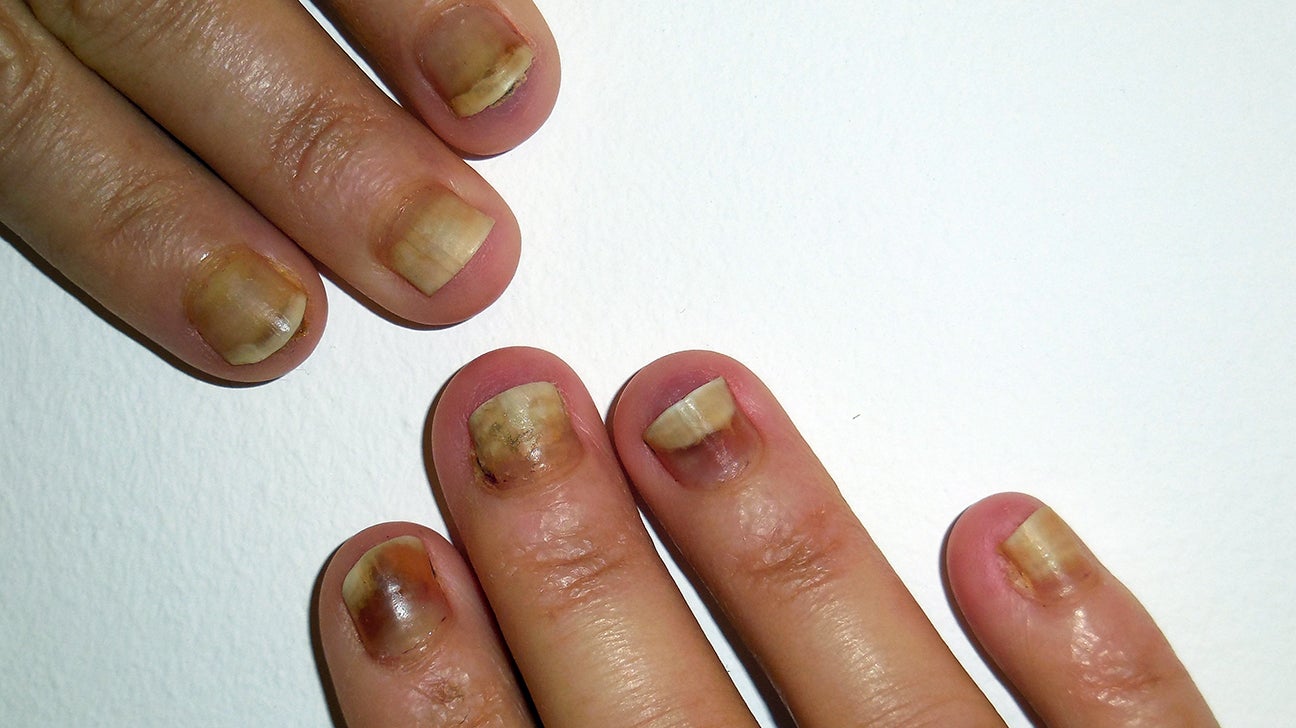 Can Nail Beds Grow Back: Exploring Nail Bed Regrowth