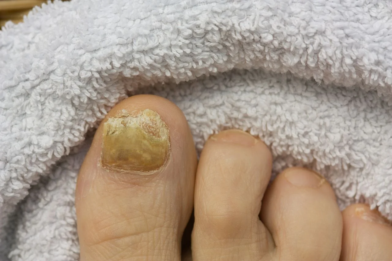 Can Toe Nail Grow Back: Understanding Toe Nail Regrowth