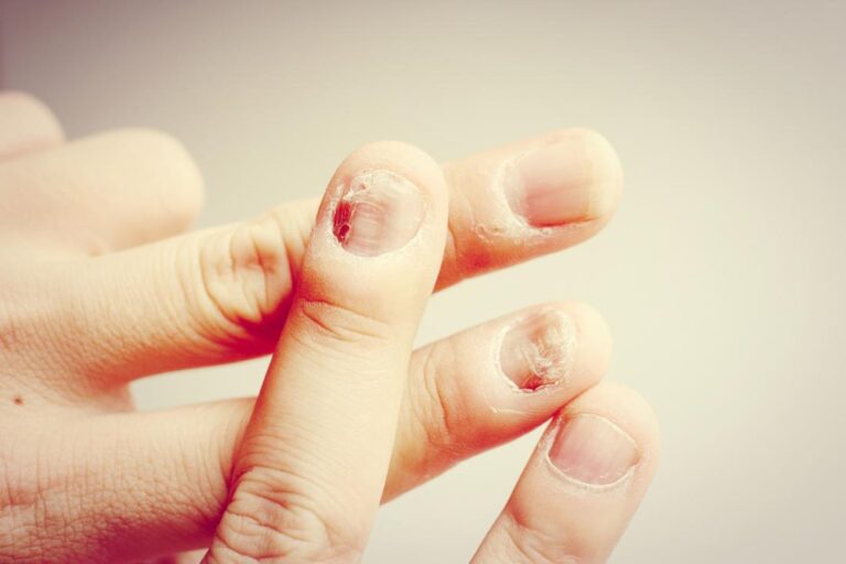 Does a Nail Fungus Hurt: Exploring the Pain Associated with Fungal Infections