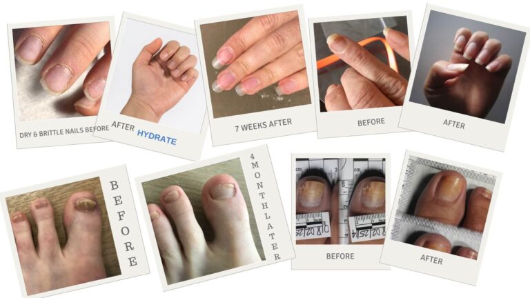 Can Nail Fungus Spread: Understanding the Contagious Nature of Nail Fungus