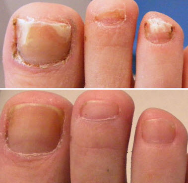 Does Nail Fungus Hurt: Understanding the Symptoms of Fungal Infections