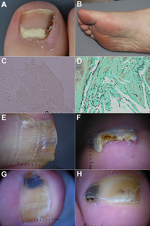 Can Nail Polish Cause Fungus: Investigating the Link Between Nail Polish and Fungal Infections