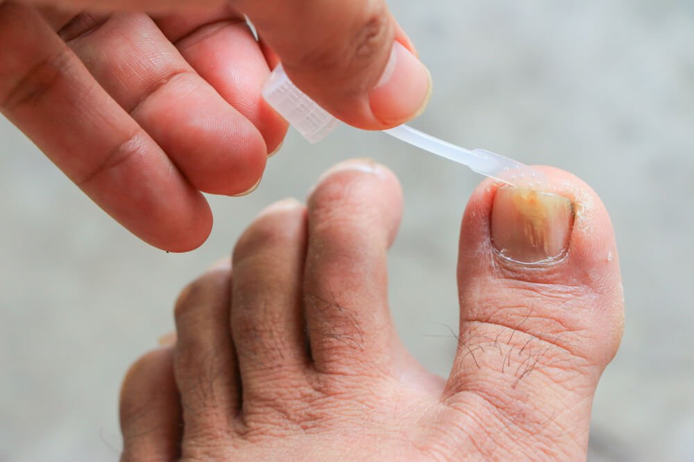 Is a Nail Fungus Contagious: Understanding the Contagious Nature of Fungal Infections