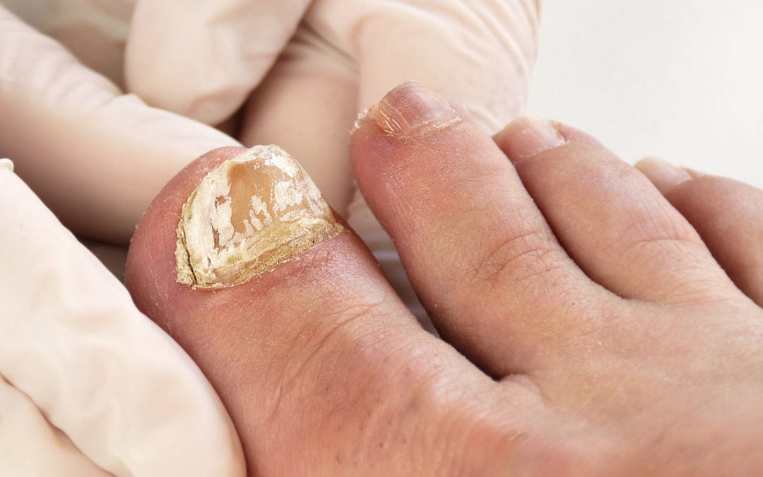 Can Toenail Fungus Spread: Understanding the Spread of Toenail Fungus