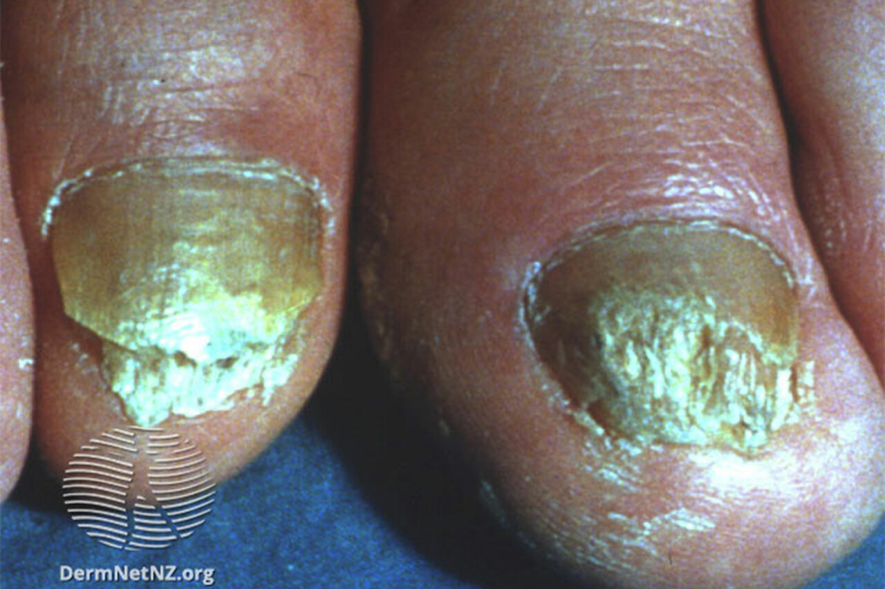 Why Toe Nail Yellow: Exploring Causes of Discolored Nails