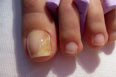 Can Nail Polish Cause Fungus: Investigating the Link Between Nail Polish and Fungal Infections