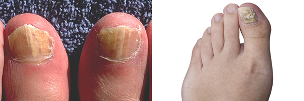 Does Nail Fungus Hurt: Understanding the Symptoms of Fungal Infections