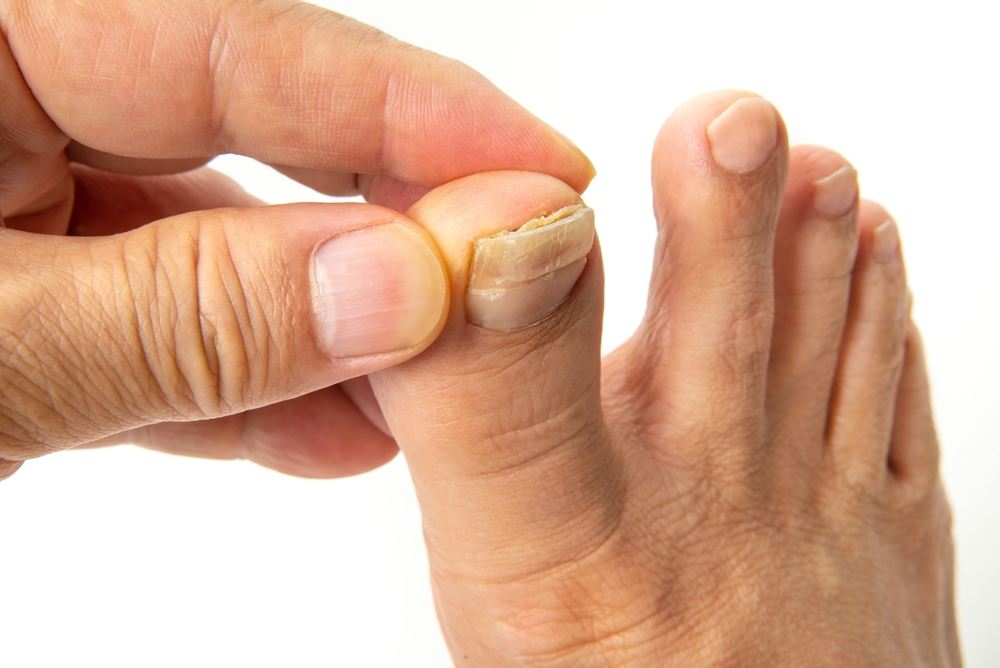 Is a Nail Fungus Contagious: Understanding the Contagious Nature of Fungal Infections