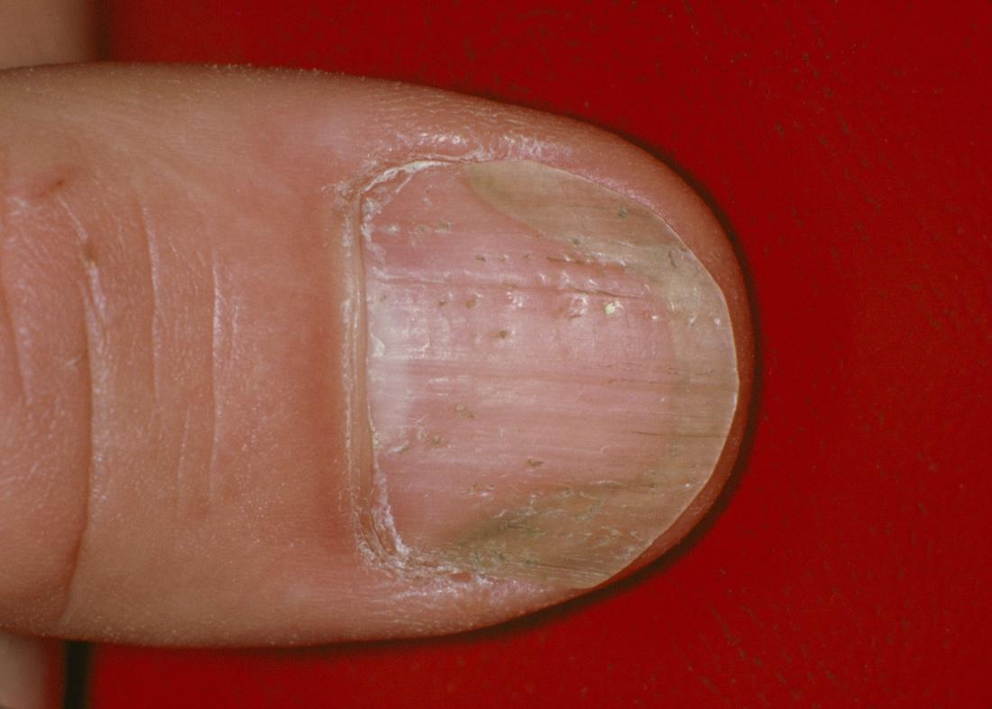 Does Nail Fungus Hurt: Understanding the Symptoms of Fungal Infections