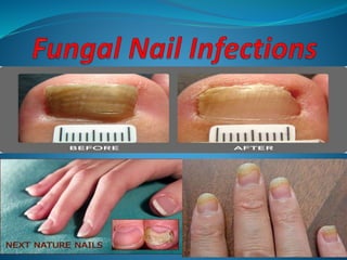 Can Nail Polish Cause Fungus: Investigating the Link Between Nail Polish and Fungal Infections