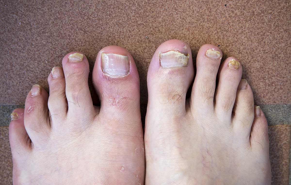 Can a Nail Fungus Spread: Understanding the Spread of Fungal Infections