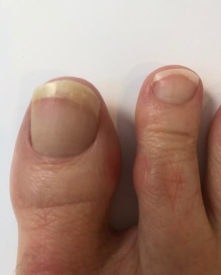 Can Toenail Fungus Spread: Understanding the Spread of Toenail Fungus