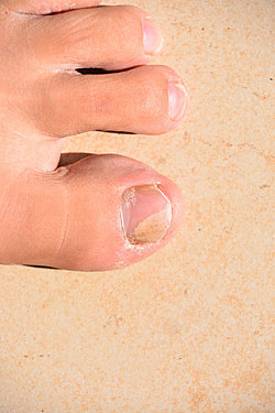 Can Toenail Fungus Spread: Understanding the Spread of Toenail Fungus