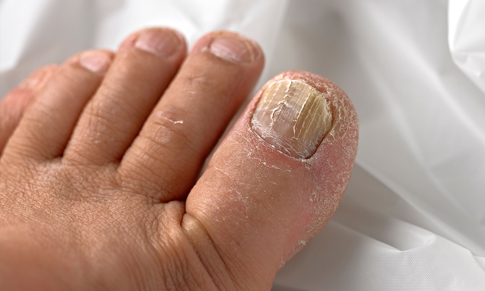 Is a Nail Fungus Contagious: Understanding the Contagious Nature of Fungal Infections